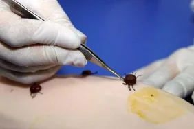 sivasta-kene-vakalari-artiyor-olu-sayisi-3e-yukseldi